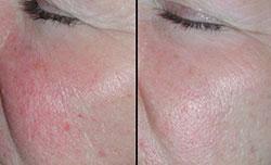 rosacea-viterbo